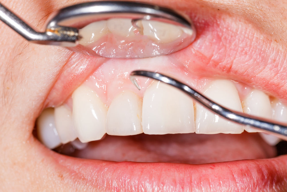 Receding gums: causes and treatments
