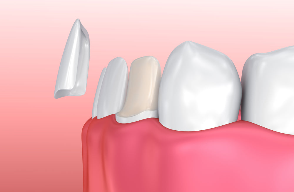 Veneers and their types - Get to know more about their alternatives